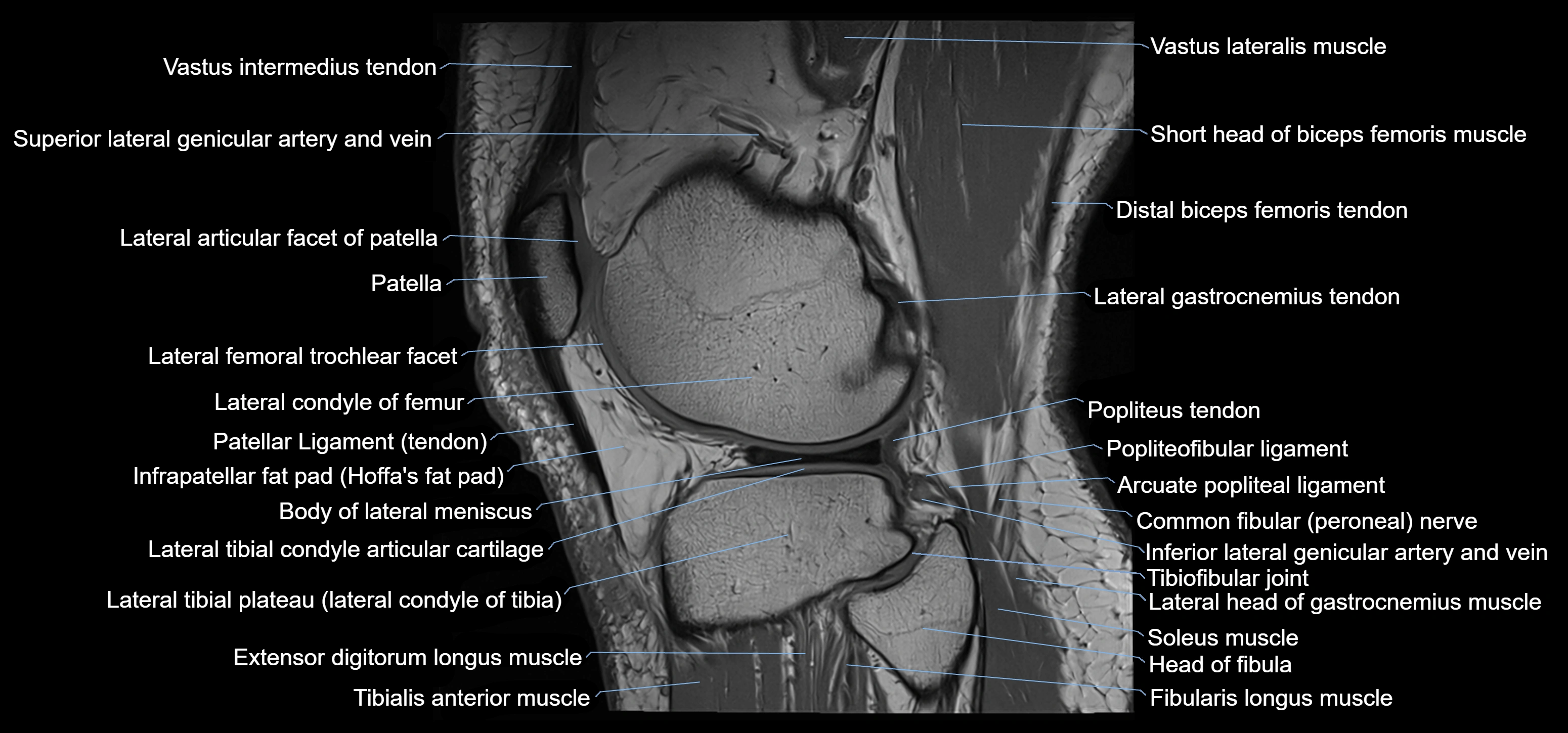 MRI knee sagittal cross sectional anatomy labelled 3T radiology image-00038.webp